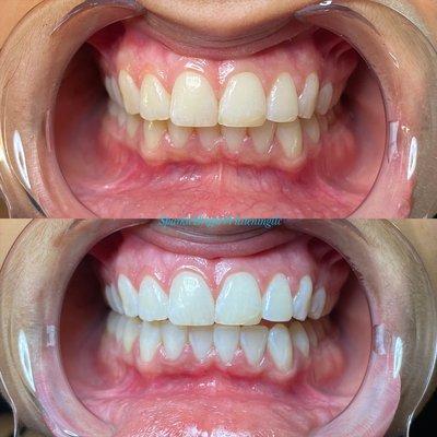 Teeth Whitening: Before & After