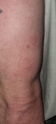 Bed bug bites