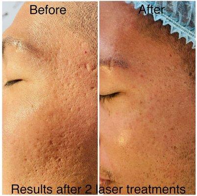 Before & After Carbon Laser Facial to treat mild scaring