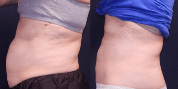 CoolSculpting