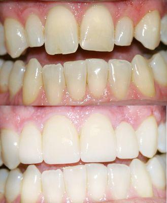 Full mouth whitening and 4 porcelain veneers to align and correct!