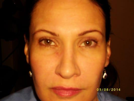 Before Laser Photofacial for acne spot and fine lines.