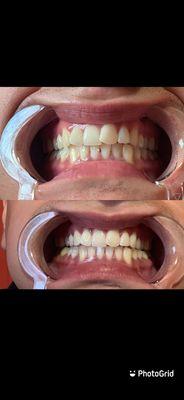 Teeth whitening and/or Gem Placement