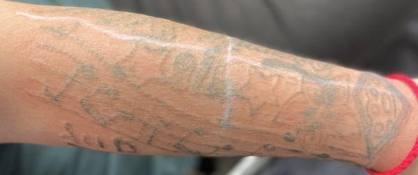 NEO Tattoo Removal & Fading