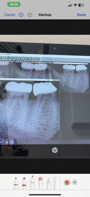 The open contact after second set of crowns