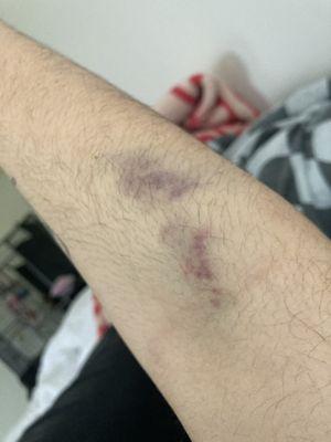 Bruised arm from the technician failing to do a blood draw