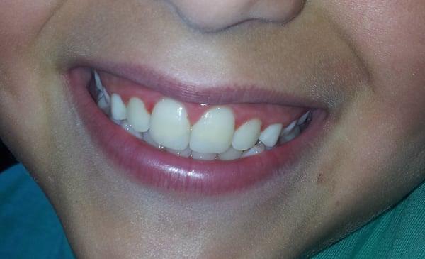 After my 9 y.o. appointment with Dr Berger to repair his two smashed teeth - beautiful smile!!