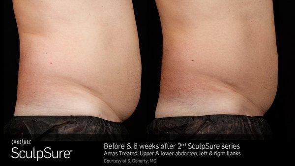 Before & After SculpSure