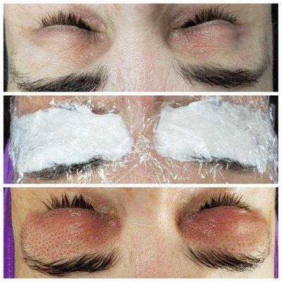 Plasma Skin Tightening - eyelid lift