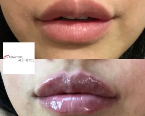 Lip filler before and after