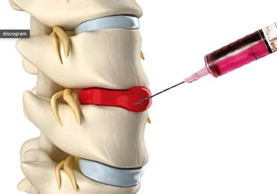 A special dye is injected into the injured disc or series of discs. The dye makes the disc visible on a fluoroscope monitor and x-ray film.