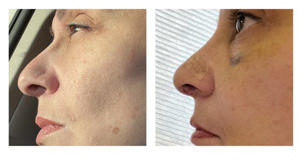 Rhinoplasty results