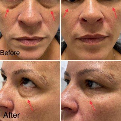 Under eyes fillers