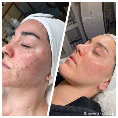 Face Reality Acne Treatment