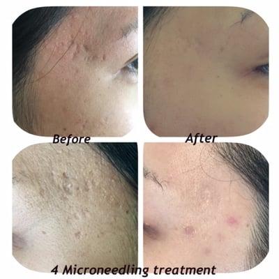 Treating Acne Scar with Microneedling treatment