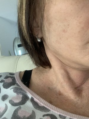 Had laser on neck in November   Crazy brown spots are still there