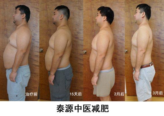 Acupuncture for weight lose - Real patient Before - after 15 days - after 2 months- after 3 month