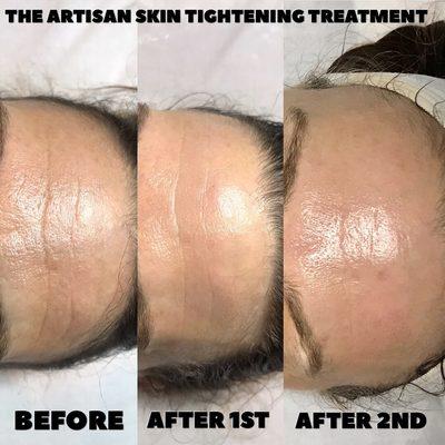 Artisan Skin Tightening Treatment on the Forehead. Natural and non invasive!