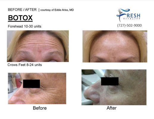 Botox Cosmetic-Real FDA Approved  Forehead Lines & Crow's Feet Treatment