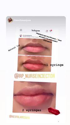 Rhonda Policandriotes RN BSN CANS  Instagram @injectionsby_rhonda Facebook Rhonda Policandriotes  #lipfillers #botox #bestlips