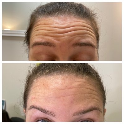 Botox before and after