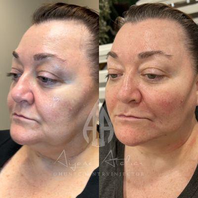 Full-face rejuvenation