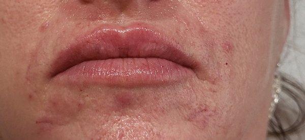 Lips after subtle enhancement