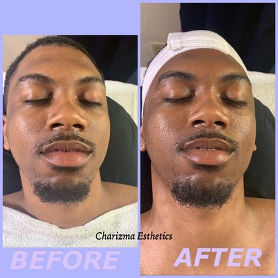 Men's charm facial