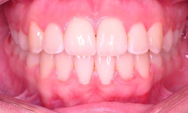 Wang Orthodontic Patient "B" After