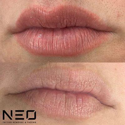 PMU REMOVAL - LIP BLUSH

BEFORE & AFTER - 3 TREATMENTS AT NEO