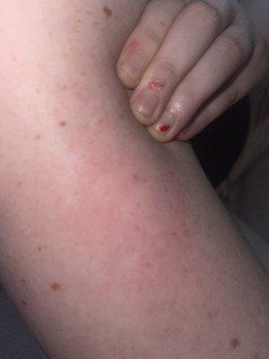 More bed bug bites