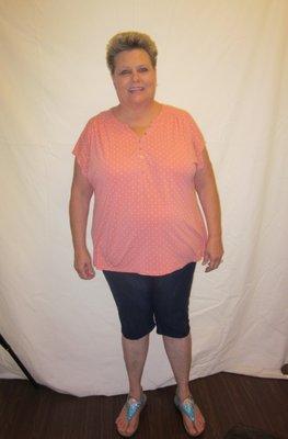 Patient Before Medi Weightloss