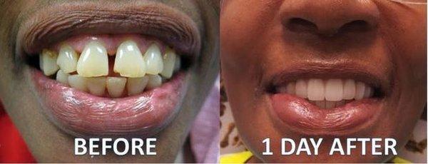 Before & After Results from Advanced Oral Surgery of Tampa | Wesley Chapel, FL