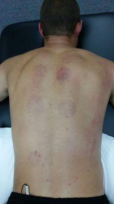 Cupping at Dynamic Edge PT