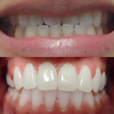 Before and after treatment with Six Month Smiles! Call us today to schedule your free consultation at 209-667-2216 :)