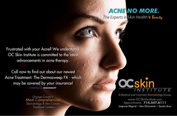 Acne Treatment Available!