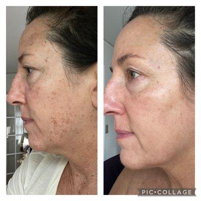 Results after one BBL treatment to help with the discoloration from sun damage on my face. PHENOMENAL! Marla at AesthestiSpa rocks!