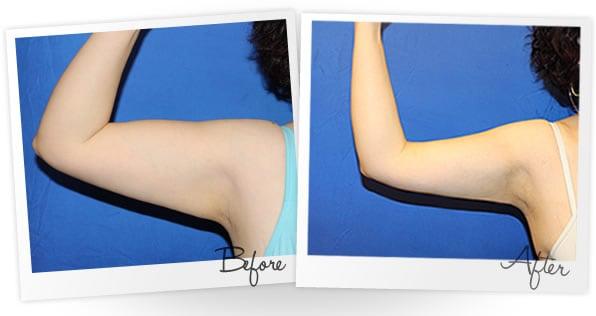 Before & After of SMARTLipo on the arms