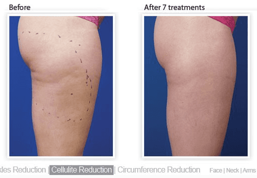 Cellulite reduction.  Skin firming. Non-surgical lipo reduction . Fat melting. Fat burning treatments.