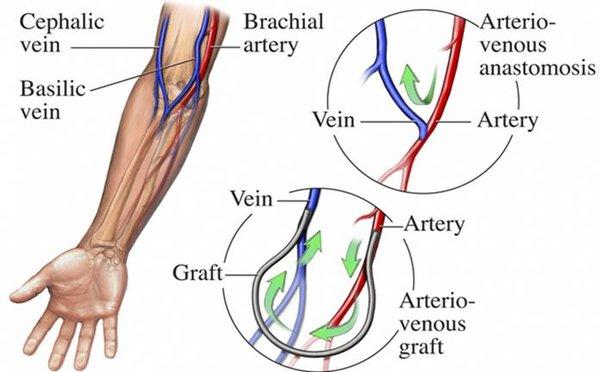 Fistula for dialysis treatment