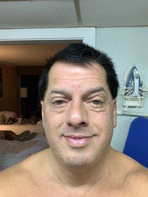 Pre-Op one day before getting eyes (blepharoplasty) which involves removing excessive fat under both of my eyes.