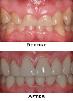 Smile make-over with Porcelain Crowns (All-ceramic)