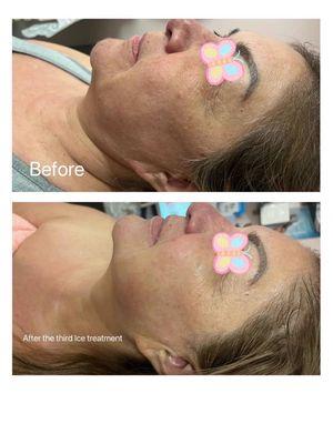 Face contouring effects just after the third time Ice Resculpting treatment!  This is one of my happy  clients' feature!