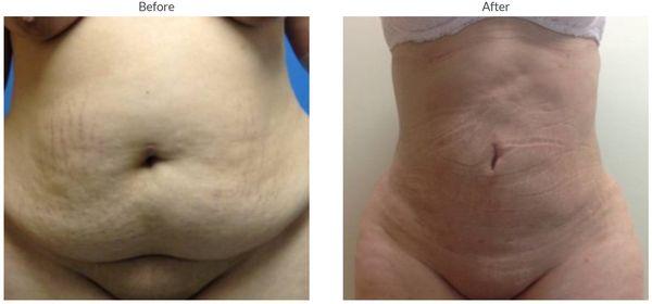 Amazing VASER Liposuction results achieved in just ONE session with Dr. Moreano