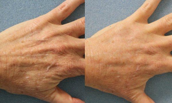 Fillers take ages off of your hands done here at REN Dermatology.