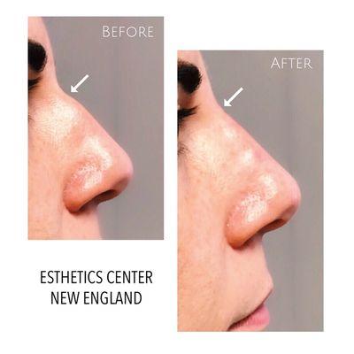 Nonsurgical Rhinoplasty