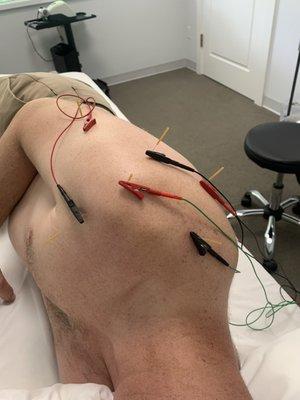 My shoulder treatment with dry needling