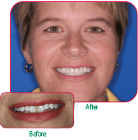 Before and After shots of Dr. Young's gentle dental care.