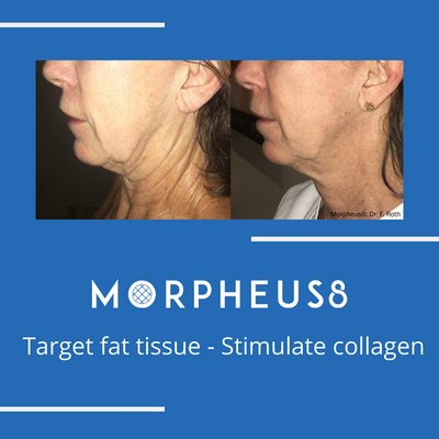 Morpheus8 microneedlingRF  is fantastic for skin tightening, and smoothing unwanted lines and wrinkles. You can also treat the body.