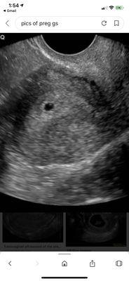 Confirmation of a healthy positive Intrauterine Implantation ( First Ultrasound to visibly see )